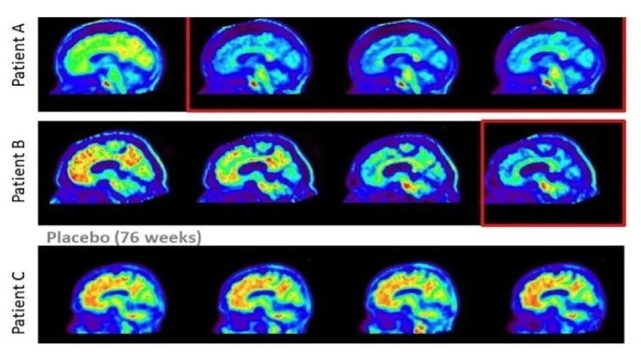 Alzheimer hastaları için büyük umut!