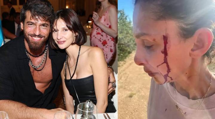Can Yaman'ın sevgilisi, kanlar içinde paylaşım yaptı